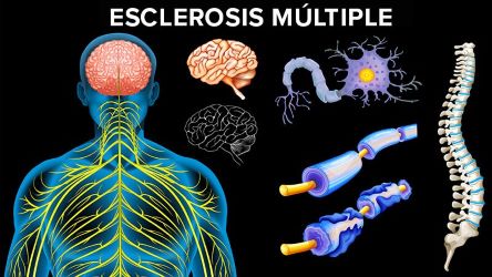 Presentan Innovador Medicamento VS la Esclerosis