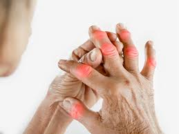 Cuidado con el Dolor Articular, Podría Ser Artritis