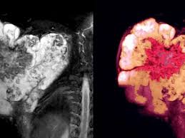 Aprueba la FDA Primera Terapia Genética Contra Sarcoma Sinovial