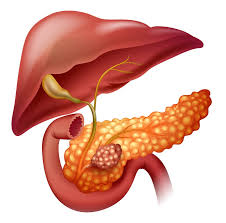 Dificil de Diagnosticar el Cáncer de Páncreas