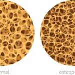 Osteoporosis el Mal de Las Mujeres