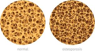 Osteoporosis el Mal de Las Mujeres